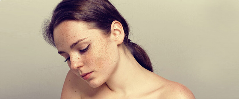 pelle-e-macchie-pigmentate-cosa-sono-perche-vengono-e-come-prevenirle